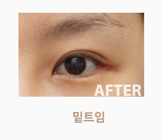 눈꼬리내리기수술(밑트임)이란?