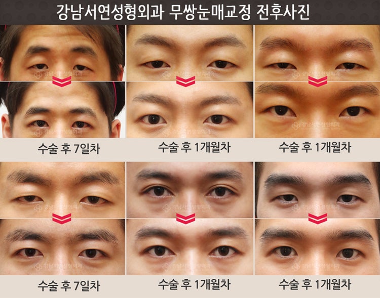 남자무쌍눈매교정, 최동일원장님 미국학회지(APS) 논문발간