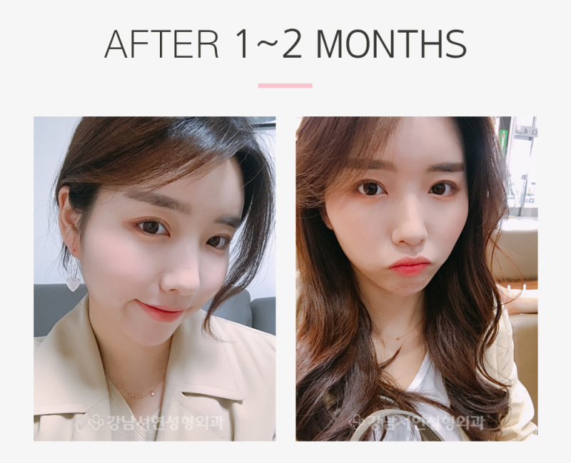 강남서연성형외과 쌍꺼풀(절개)+눈매교정 리얼스토리