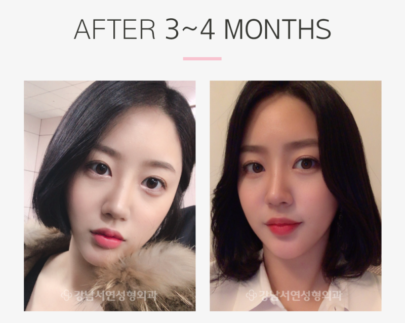 강남서연성형외과 눈매교정(재수술)+코성형+지방이식(이마) 리얼스토리