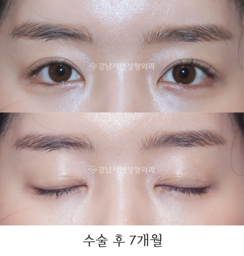 강남서연성형외과 절개눈매교정 전후 사진