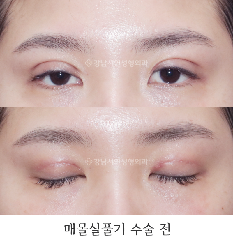 강남서연성형외과 매몰실풀기+매몰 재수술 / 라인낮추기 전후 사진