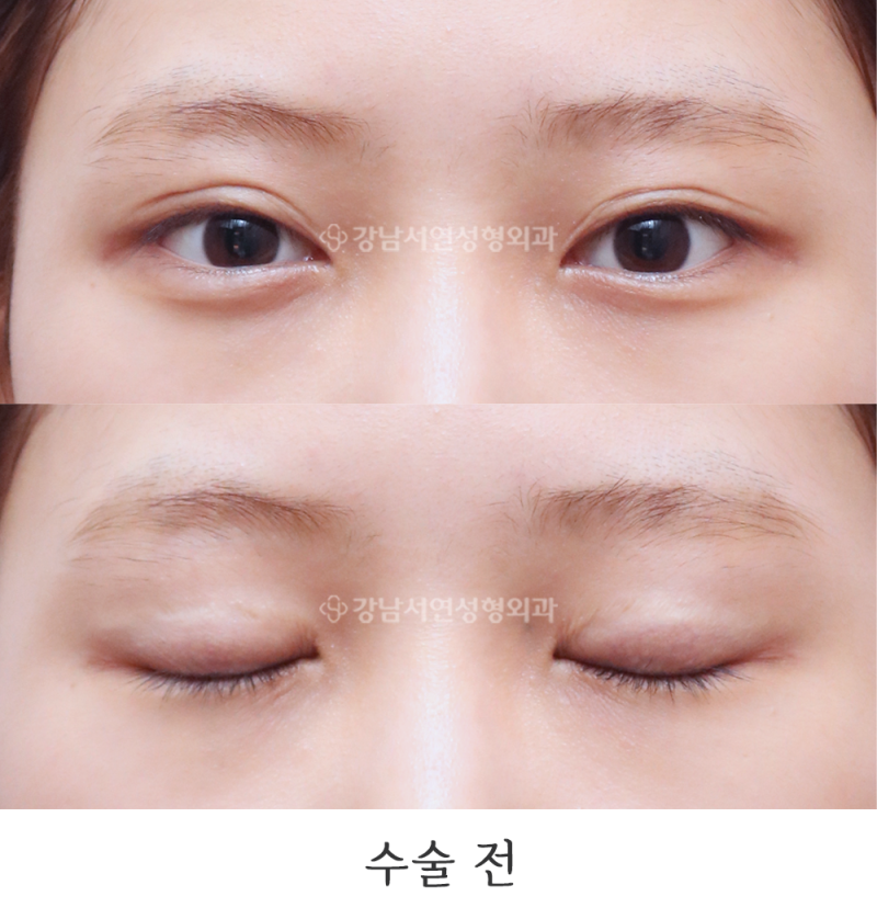 강남서연성형외과 쌍꺼풀 재수술(두줄따기 / 라인낮추기) 전후 사진