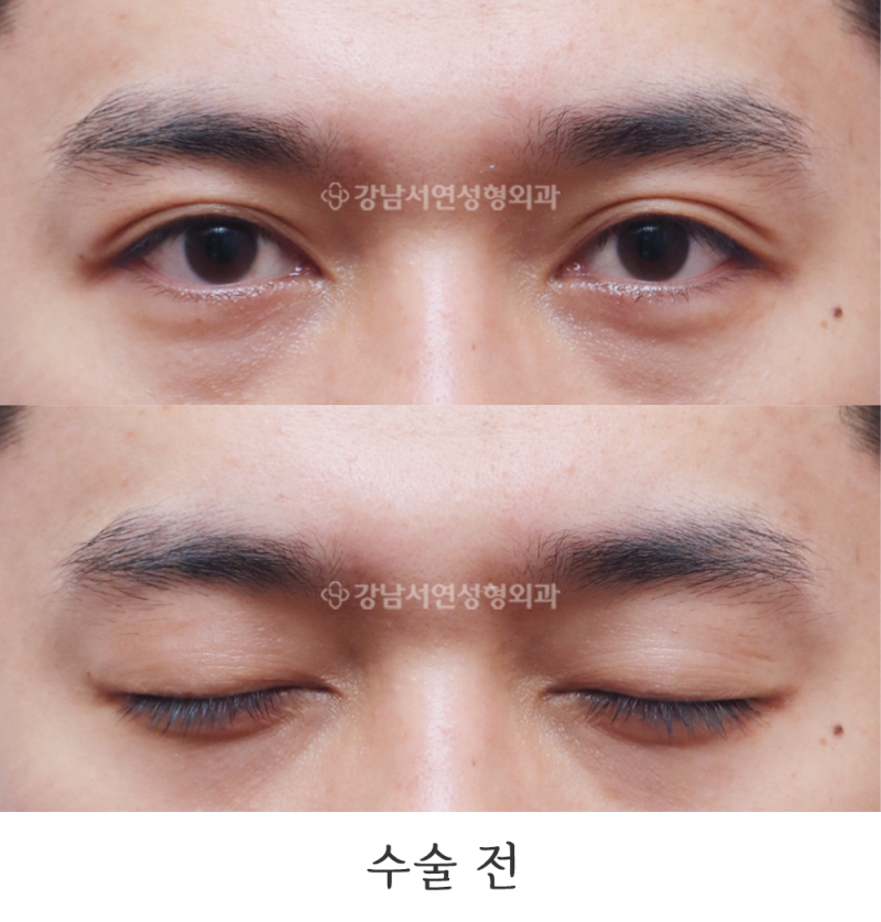 강남서연성형외과 남자 절개눈매교정 / 무쌍눈매교정 / 쌍꺼풀 없애기 전후 사진