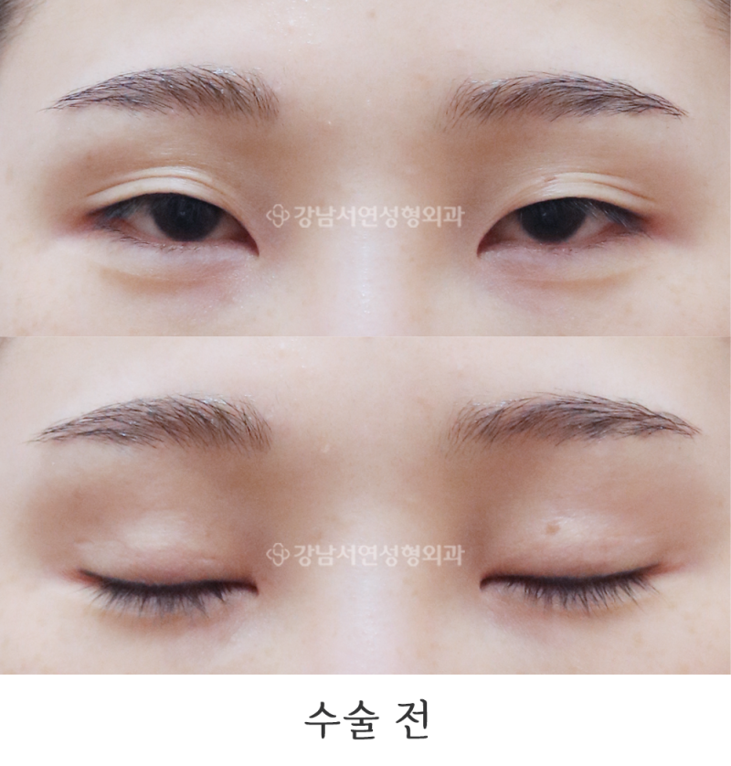강남서연성형외과 절개눈매교정 재수술, 앞트임, 뒤트임(뒷트임), 밑트임 전후 사진