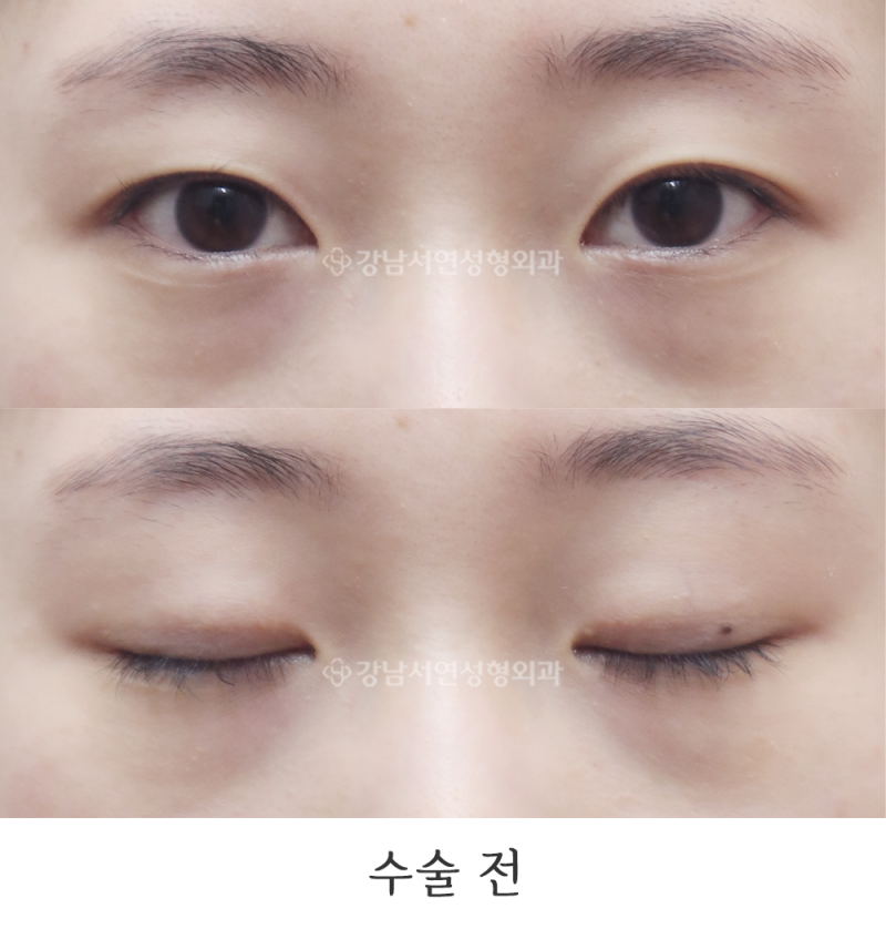절개눈매교정, 뒤트임(뒷트임), 밑트임 전후 7일, 1개월 10개월 사진