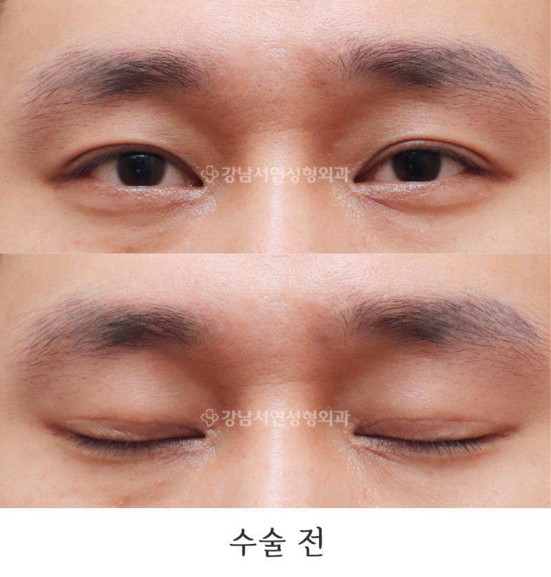 강남서연성형외과 남자 절개눈매교정 재수술 / 라인낮추기 일주일, 2달, 3달 사진