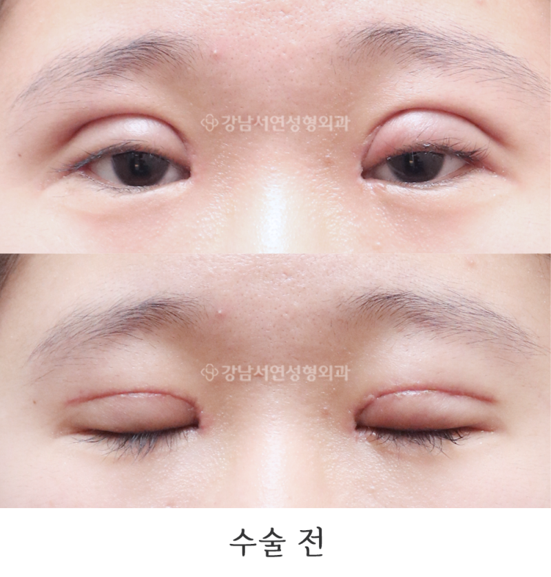강남서연성형외과 쌍꺼풀 재수술(두줄따기 / 라인낮추기) 전후 사진