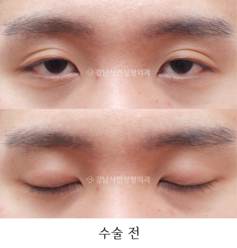 강남서연성형외과 남자 절개눈매교정 / 무쌍눈매교정 / 쌍꺼풀 없애기 + 앞트임 전후 사진