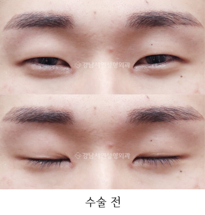 강남서연성형외과 남자 절개눈매교정, 앞트임 뒤트임, 밑트임 전후 일주일, 6개월 사진
