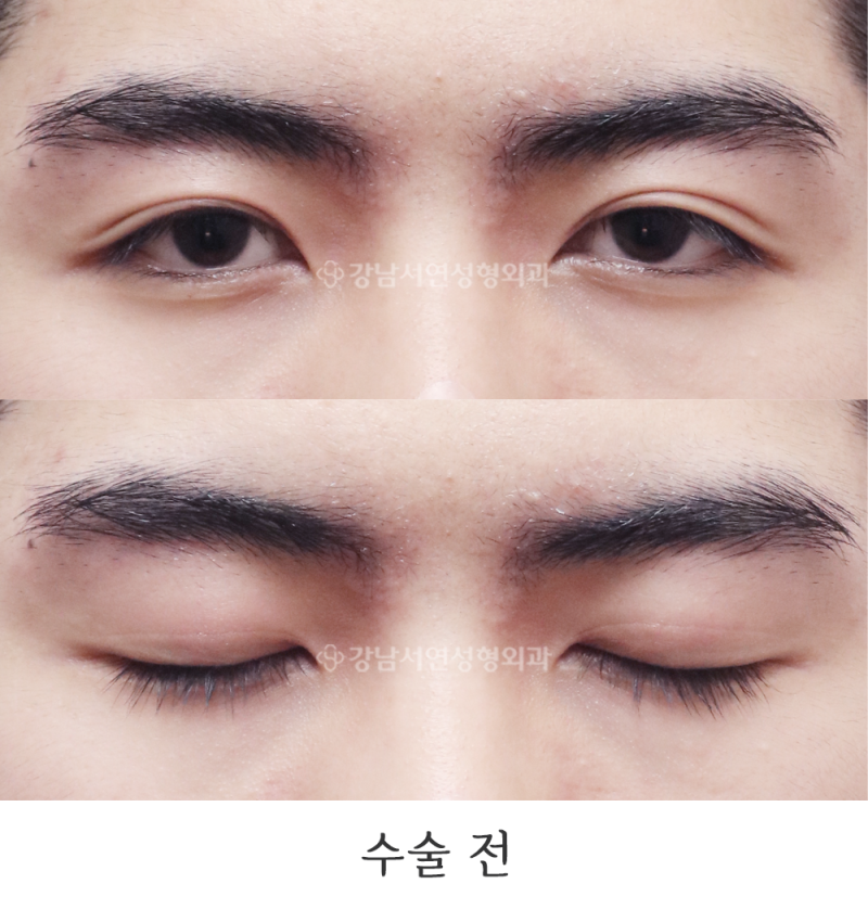강남서연성형외과 남자 절개눈매교정, 무쌍눈매교정, 라인 낮추기, 쌍꺼풀 없애기, 무쌍수술 6개월 사진