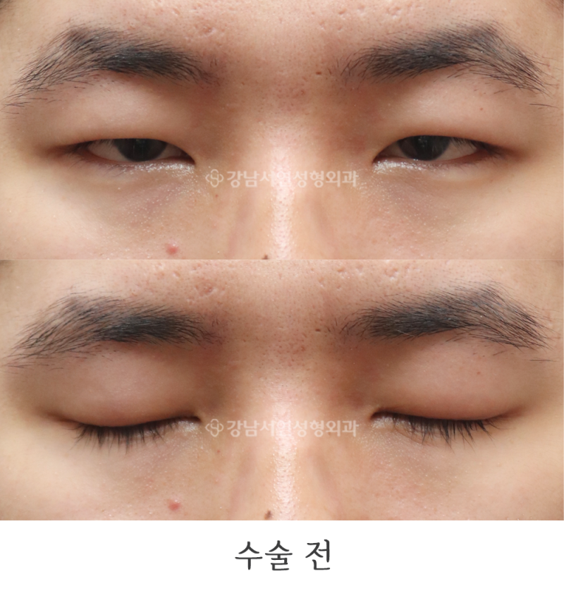 강남서연성형외과 남자 절개눈매교정, 앞트임 전후 일주일, 3개월 사진