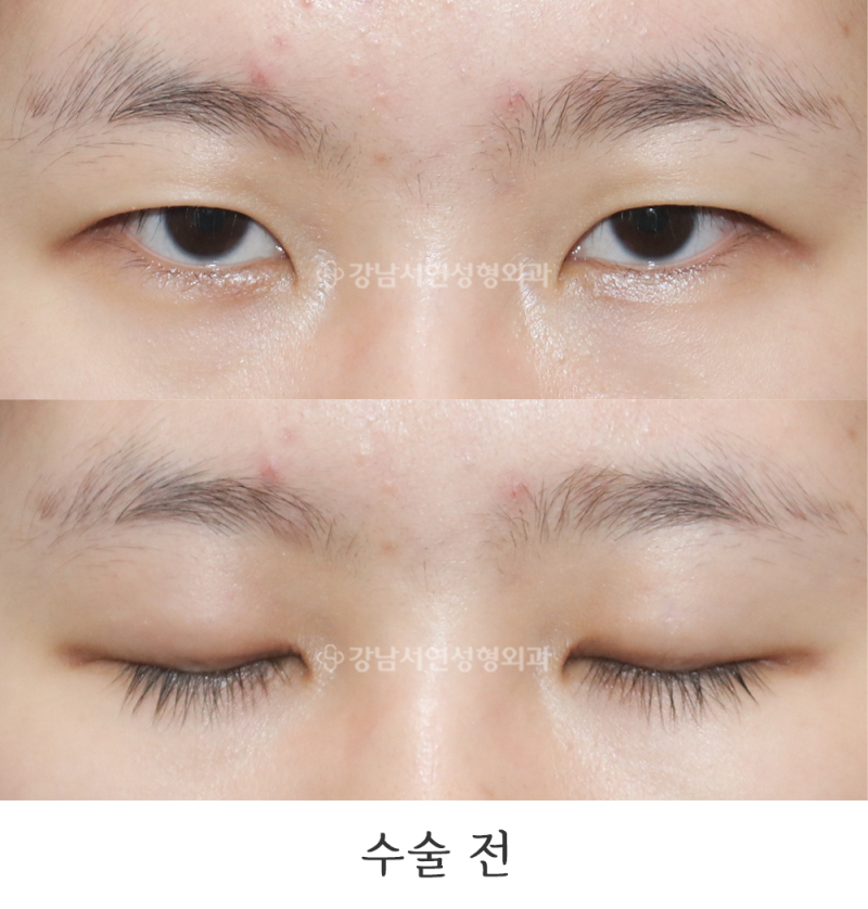 강남서연성형외과 절개눈매교정, 앞트임 뒤트임, 밑트임 전후 일주일, 6개월 사진