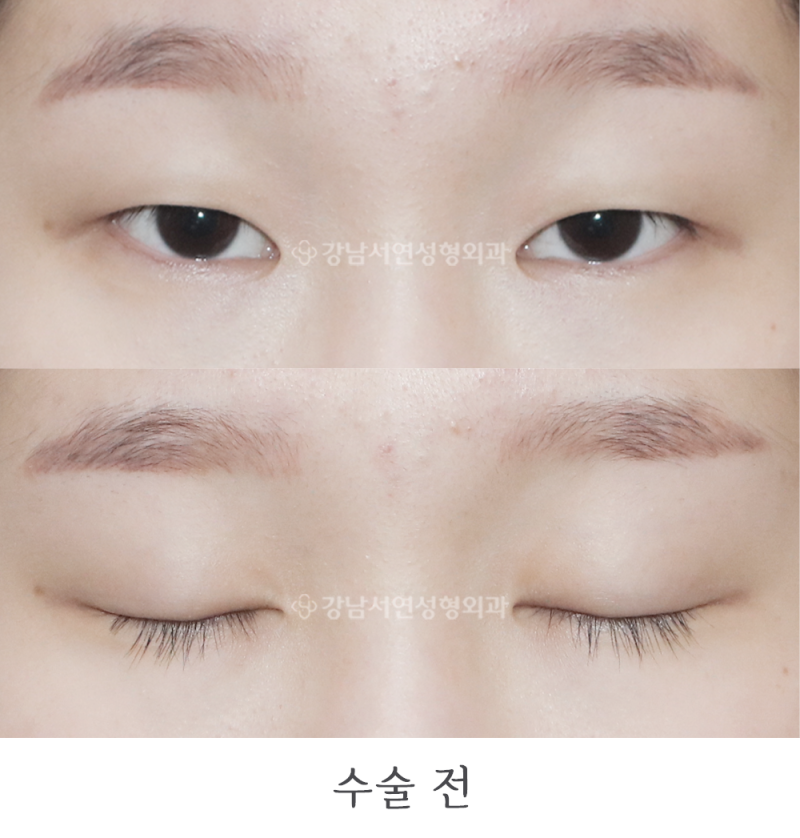 강남서연성형외과 절개눈매교정, 앞트임 전후 일주일, 1개월 사진