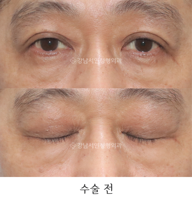 쌍꺼풀 없애기, 무쌍눈매교정 사진
