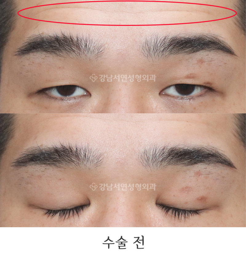 남자 무쌍눈매교정 사진(feat.강남서연성형외과)