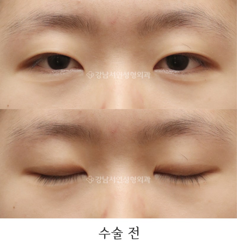 절개눈매교정, 앞트임 6개월 전후 사진(feat.강남서연성형외과)