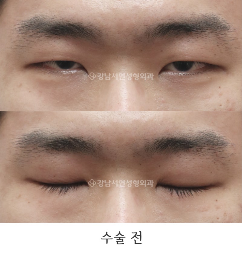 남자 무쌍눈매교정, 앞트임 6개월 전후 사진(feat.강남서연성형외과)