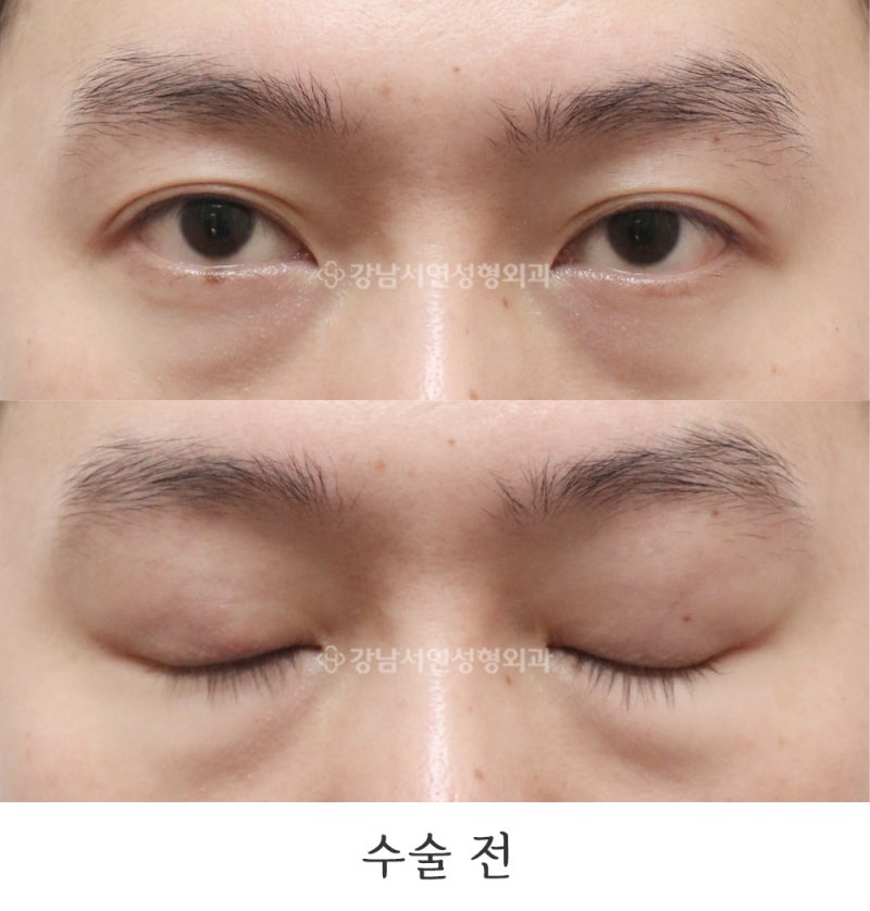 쌍꺼풀 없애기, 무쌍눈매교정 6개월 전후 사진(feat.강남서연성형외과)