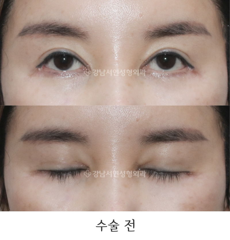 앞트임 복원 1년 전후 사진(feat.강남서연성형외과)