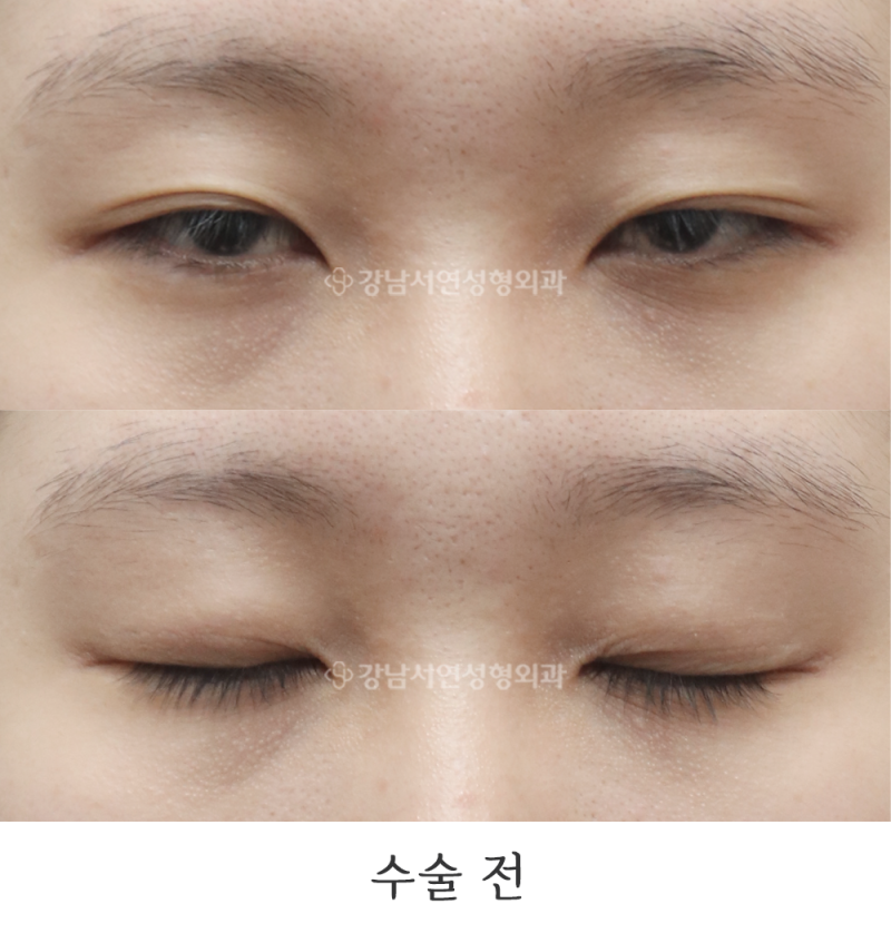 절개눈매교정, 앞트임, 뒤트임 6개월 전후 사진(feat.강남서연성형외과)