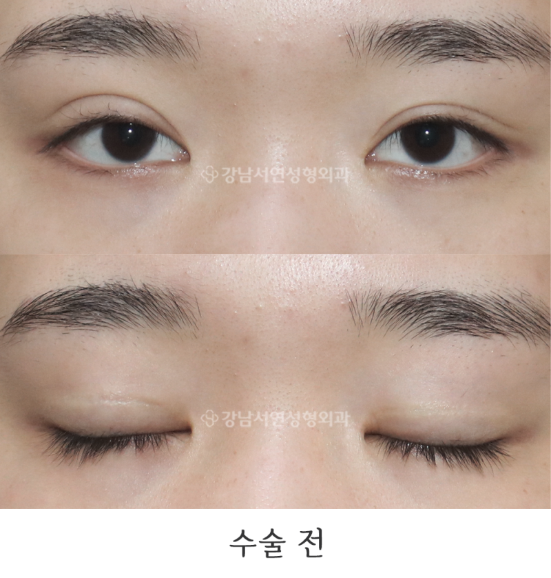 눈재수술 두줄따기 일주일, 6개월 전후사진(feat.강남서연성형외과)