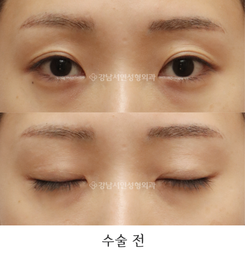 여자 쌍꺼풀 재수술 6개월 전후 사진(feat.강남서연성형외과의원)