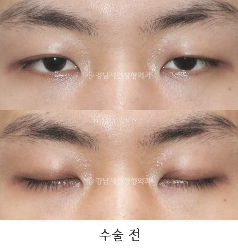 강남서연성형외과의원 남자눈매교정 전후 사진