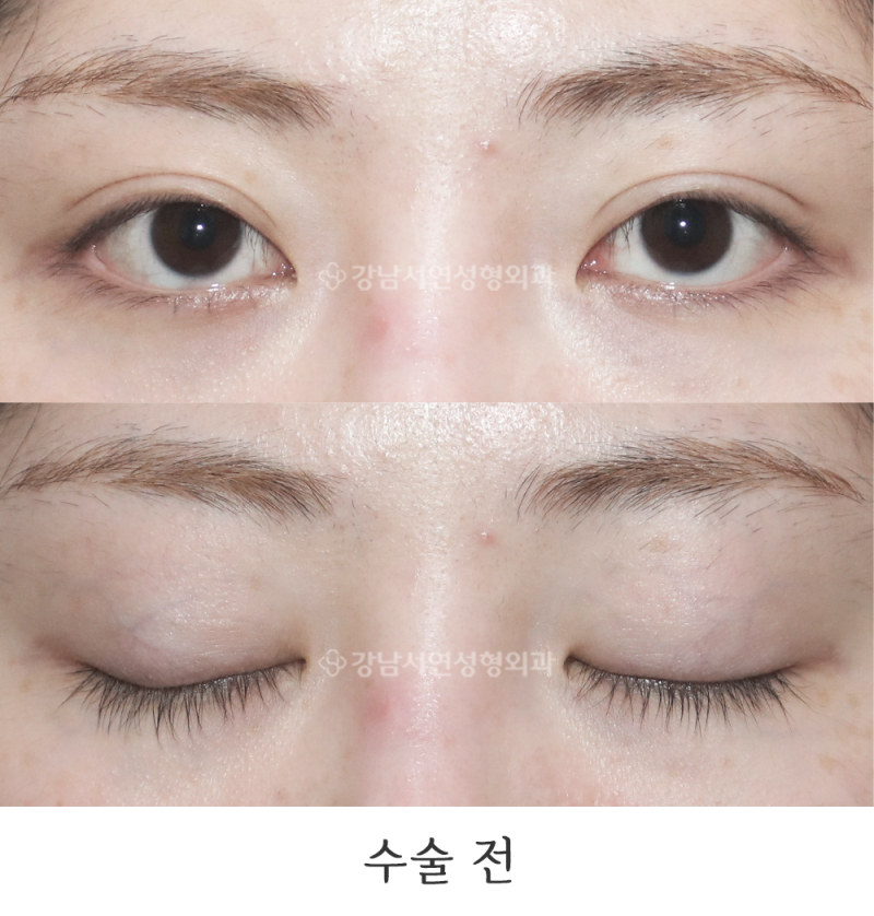 강남서연성형외과의원 쌍꺼풀 라인 낮추기 재수술 전후 사진