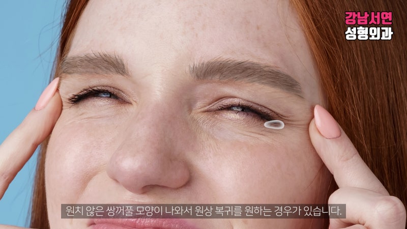 매몰실 풀기, 매몰 풀기, 매몰실 제거 제대로 알아보자