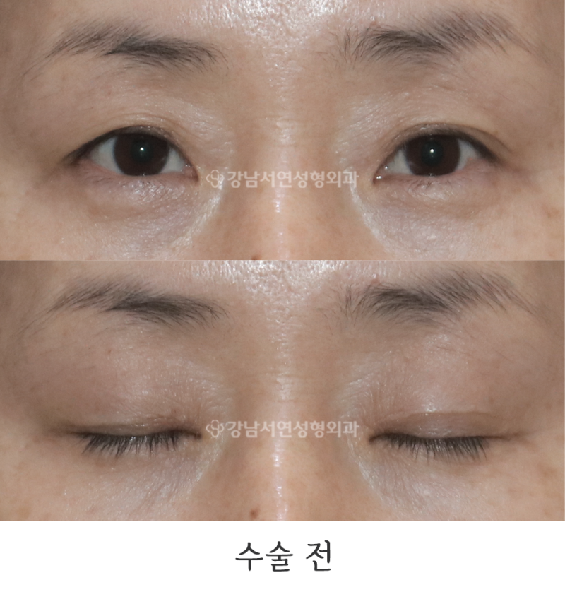 강남서연성형외과의원 상안검, 뒤밑트임 전후 사진