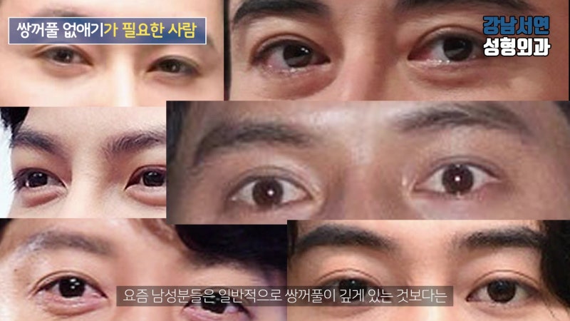남자 쌍꺼풀 없애기 수술 방법, 유의할 점, 전후사진