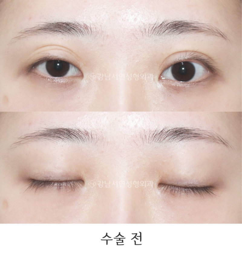 강남서연성형외과의원 쌍꺼풀 재수술(점막들림, 짝눈교정) 전후 사진