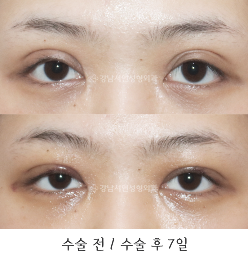 강남서연성형외과의원 라인낮추기, 겹주름교정 전후 사진