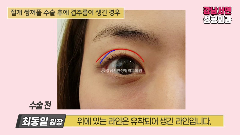 겹주름 쌍꺼풀(겹쌍꺼풀) 교정 원인과 수술 후 변화 후기