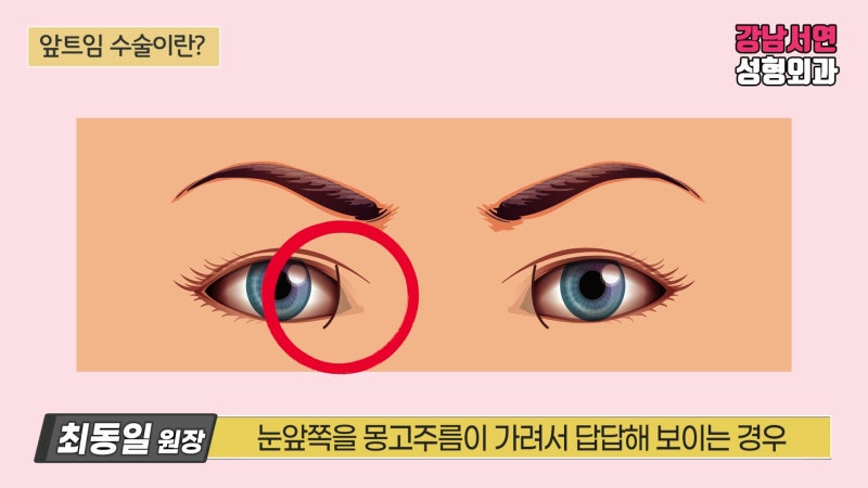 앞트임 복원 수술 방법과 흉터, 수술 후 변화 후기
