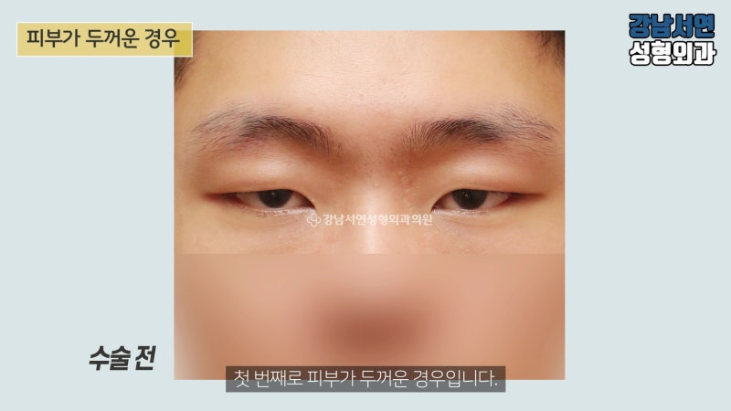 남자 비절개눈매교정 하면 안되는 이유