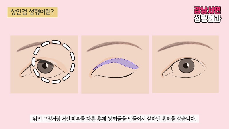 자연스러운 상안검 성형의 모든 것 수술전후 후기까지!
