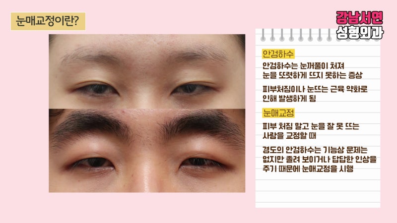 눈매교정 부작용과 그 원인, 제대로 알아보자!
