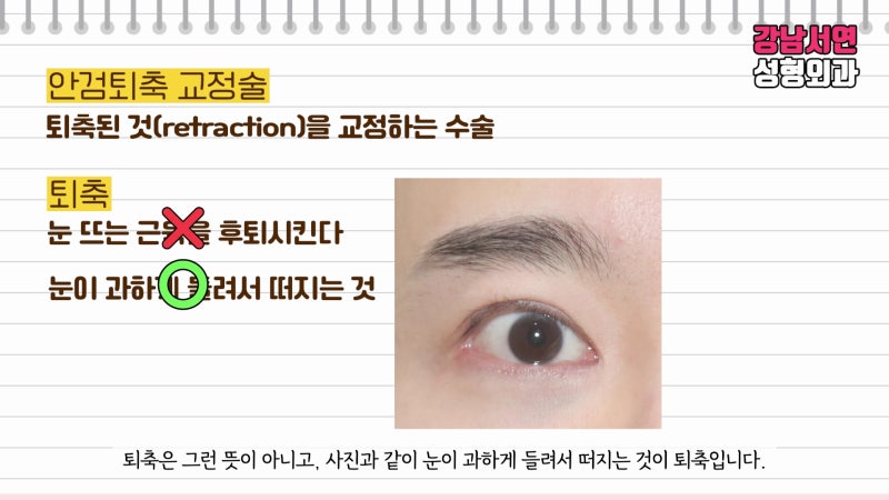 안검퇴축 정확한 뜻과 전후사진