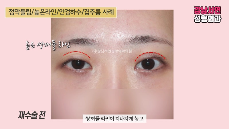 겹주름, 점막들림, 안검하수 재수술 후 4개월