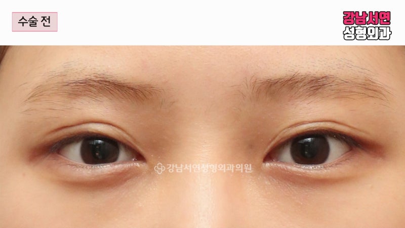 쌍꺼풀 라인 낮추기 눈 재수술 다양한 케이스와 수술 방법