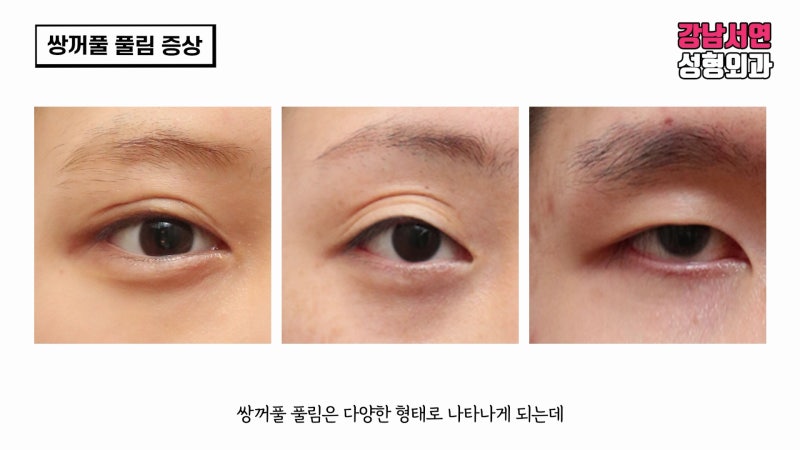 쌍꺼풀 풀림 원인과 해결방법