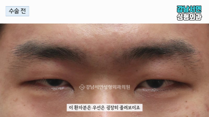 남자눈매교정 실제 수술 전후 사례로 알아보자