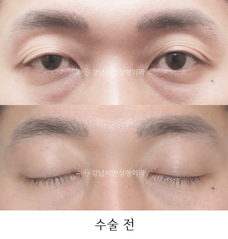 강남서연성형외과의원 남자눈매교정, 겹주름 교정 전후 사진