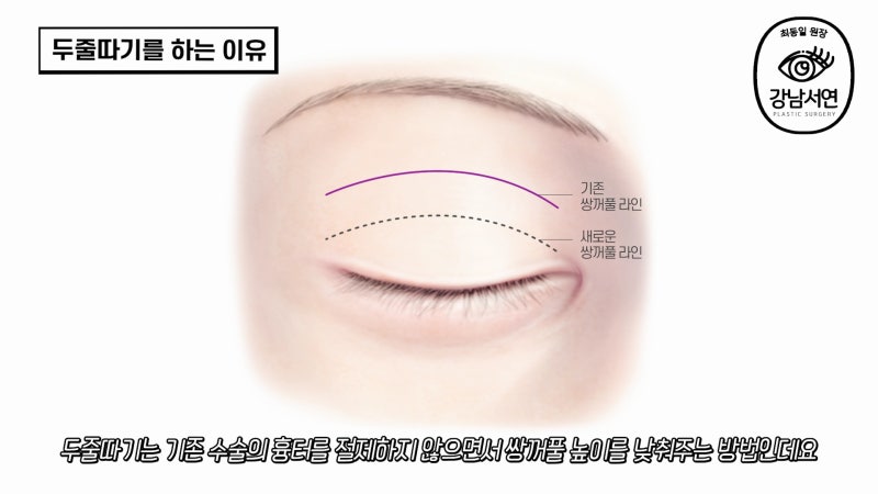 두줄따기 후 흉터, 단차에 대한 오해와 진실