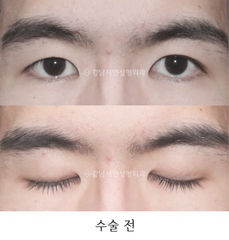 강남서연성형외과의원 매몰 실풀기, 매몰 실제거 전후 사진