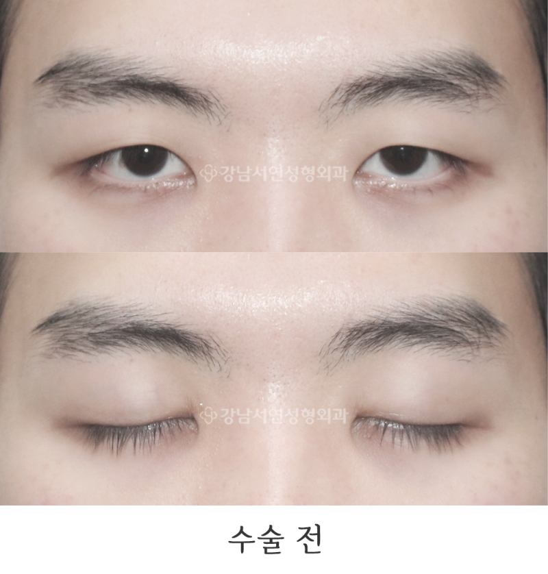 강남서연성형외과의원 남자무쌍눈매교정 전후 사진