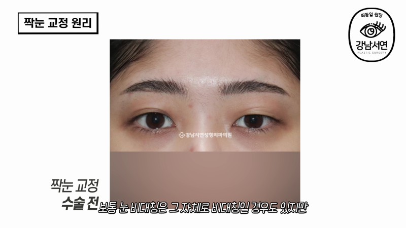 눈 성형 전문의의 짝눈 교정 원리와 성공 후기