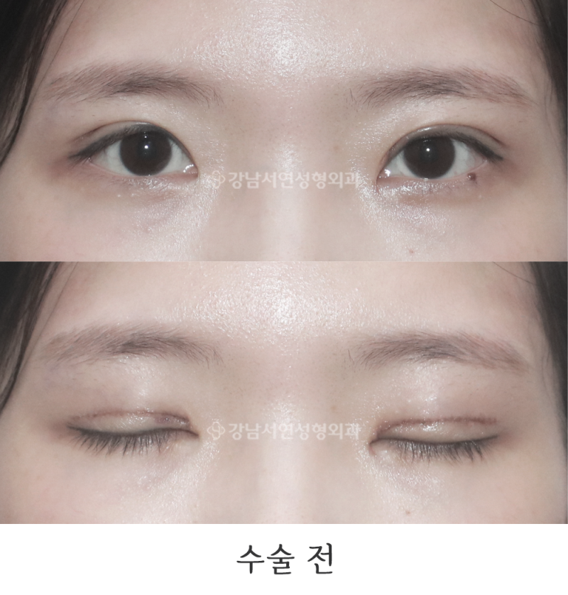 강남서연성형외과의원 절개 눈매교정 과교정 조기교정 (눈 당김 개선) 전후 사진
